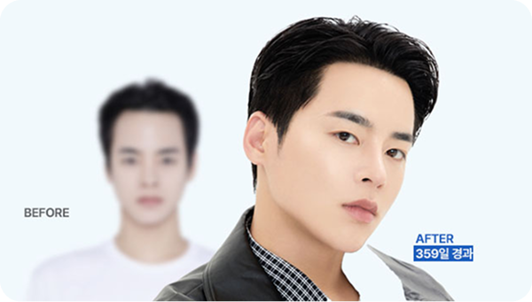 The wider forehead after childbirth, now I am confident.