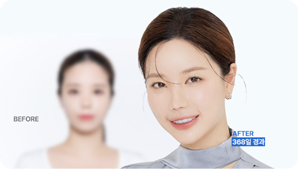 10 years of worrying about crown hair loss, finally solved!