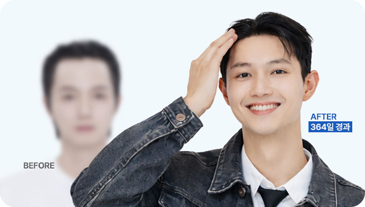 이마 줄이고, 외모 리즈 갱신