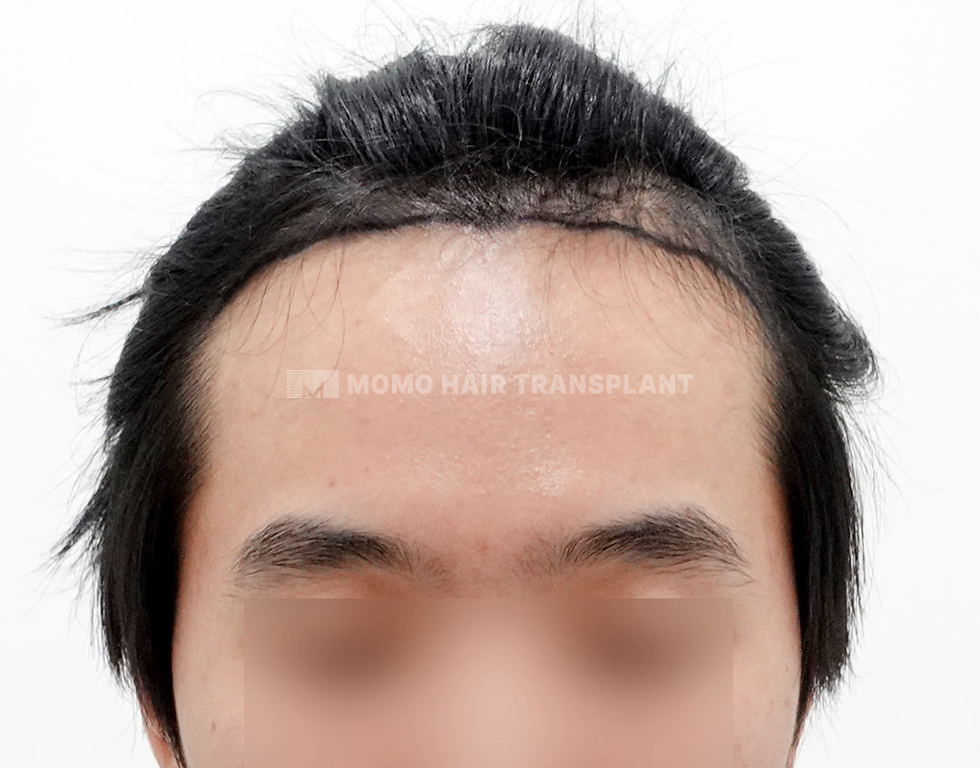 Before