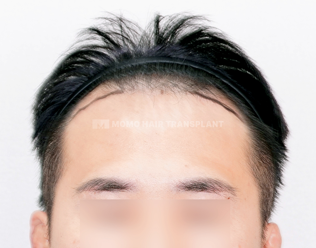 Before