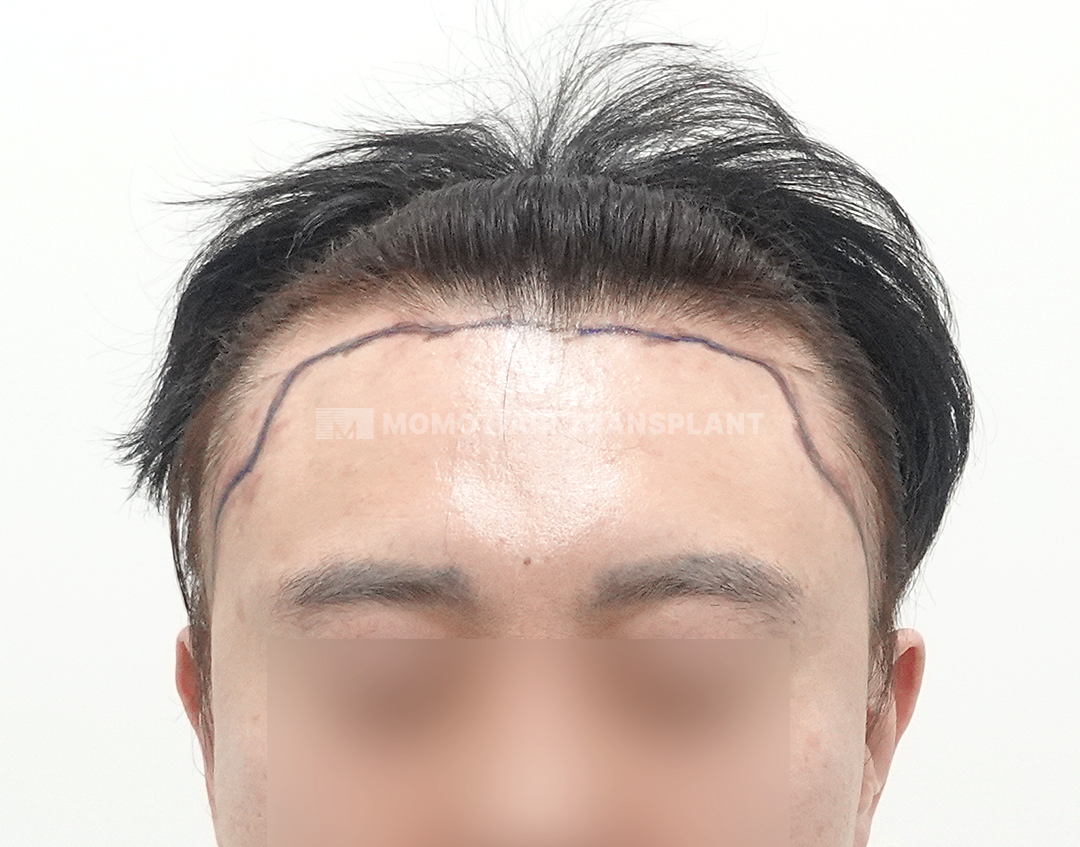 Before