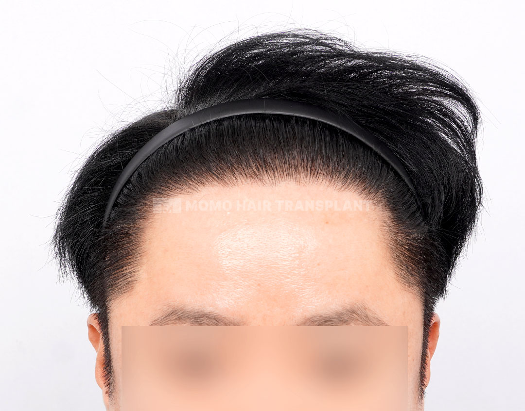 施術後
