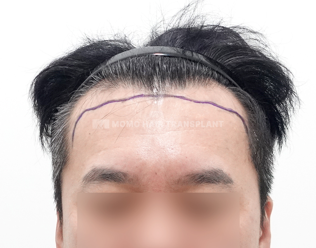 Before