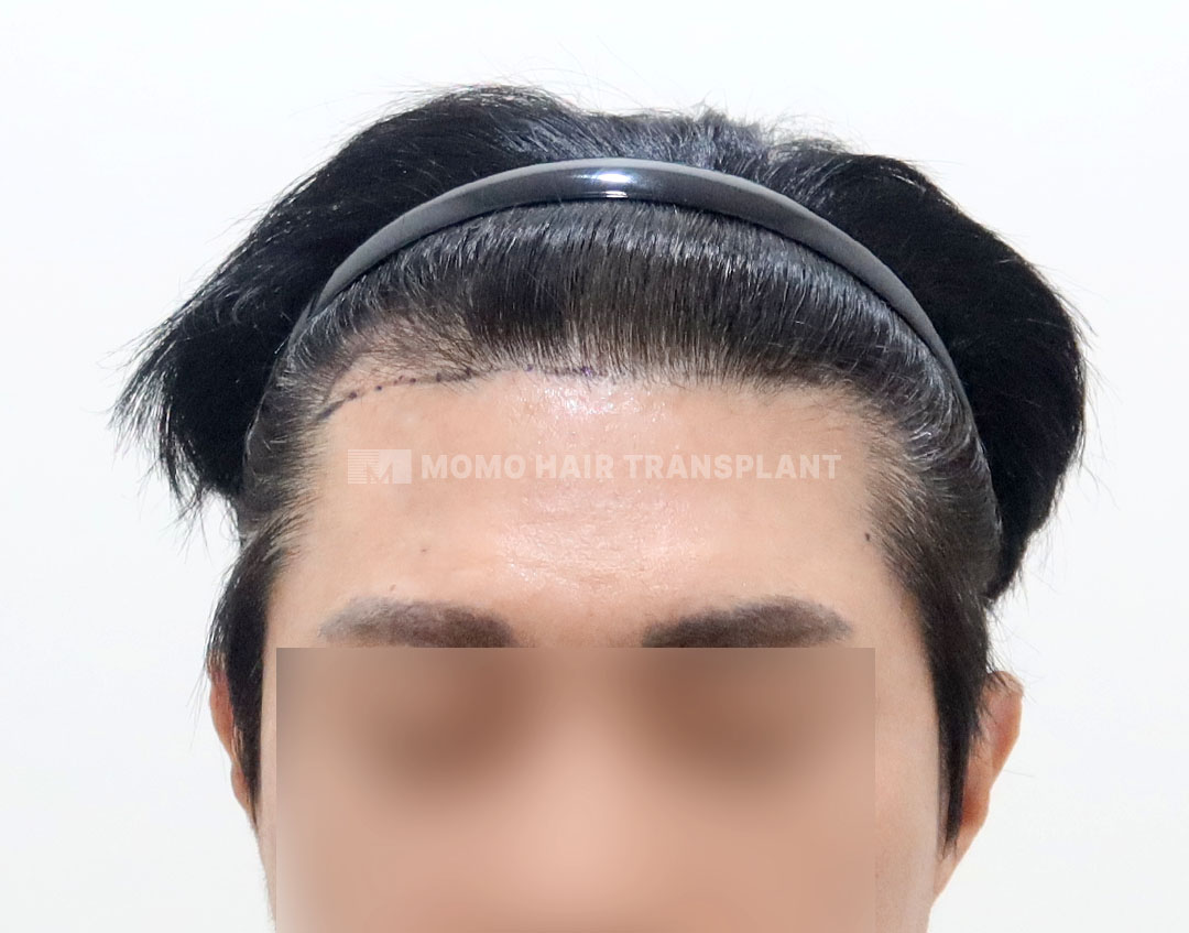 Before