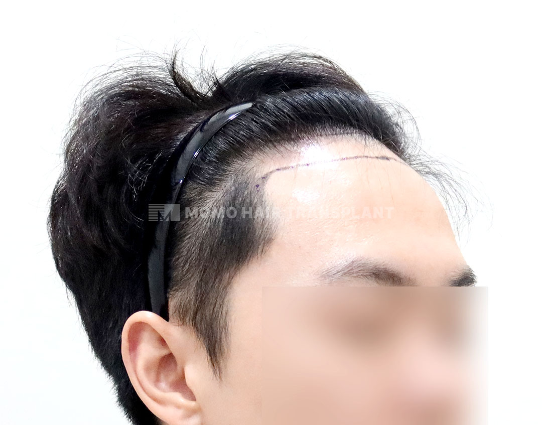 Before