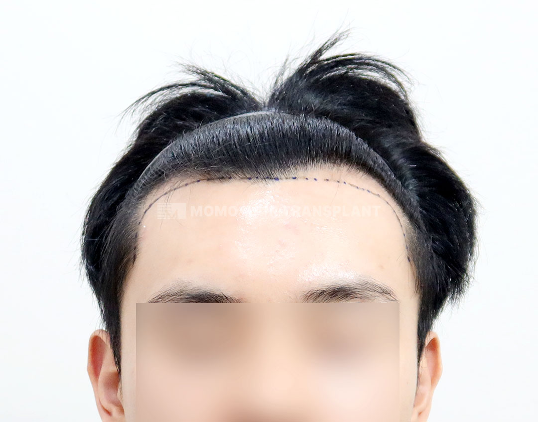 Before