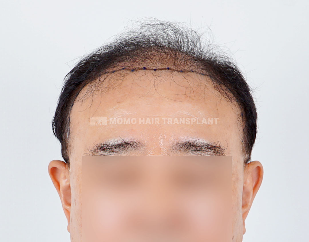 Before