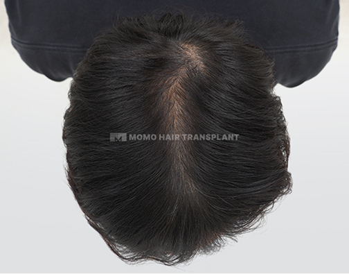 女性頭頂部植毛 after