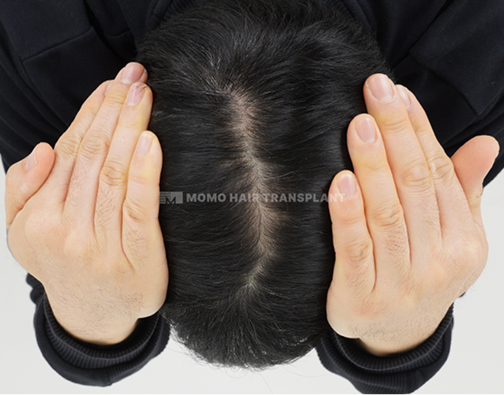 女性額リフト傷跡カバー非切開 after