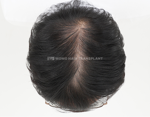 女性頭頂部植毛 before