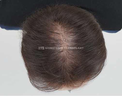 女性頭頂部植毛 before