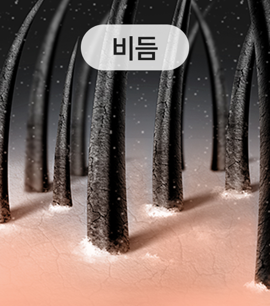 Dandruff