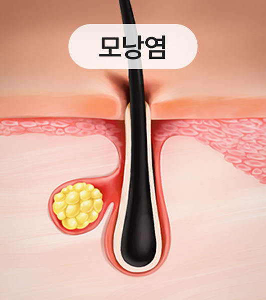 Folliculitis