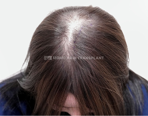 女性頭頂部植毛 before