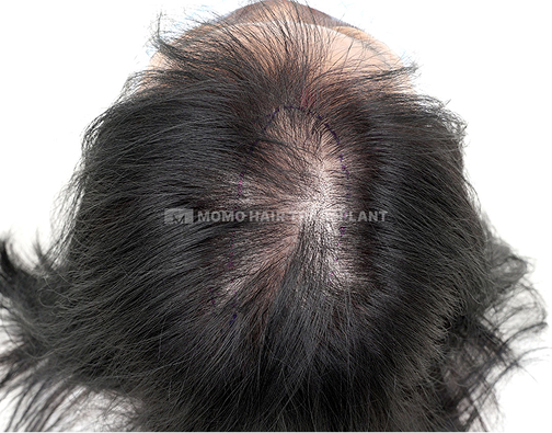 女性頭頂部植毛 before