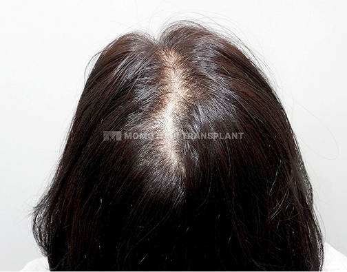 女性頭頂部植毛 before