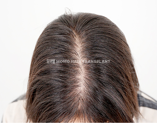 女性頭頂部植毛 before