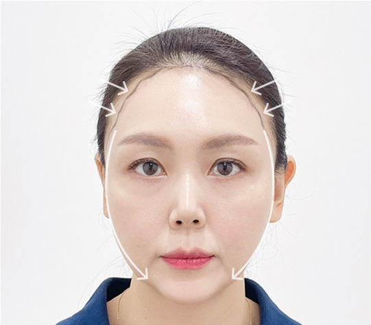 丸顔型