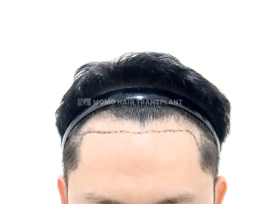 Before