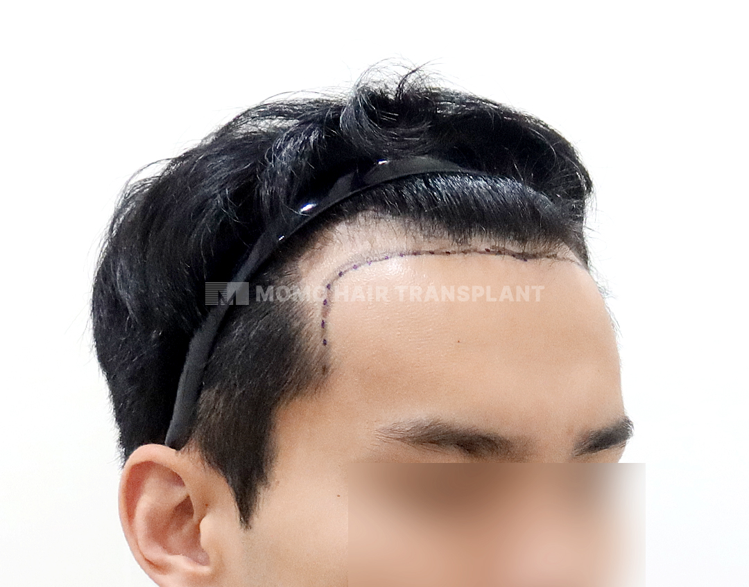 Before