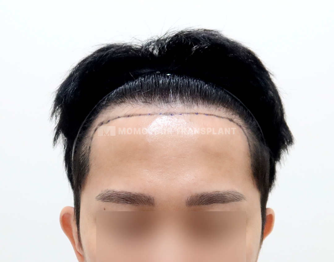 Before