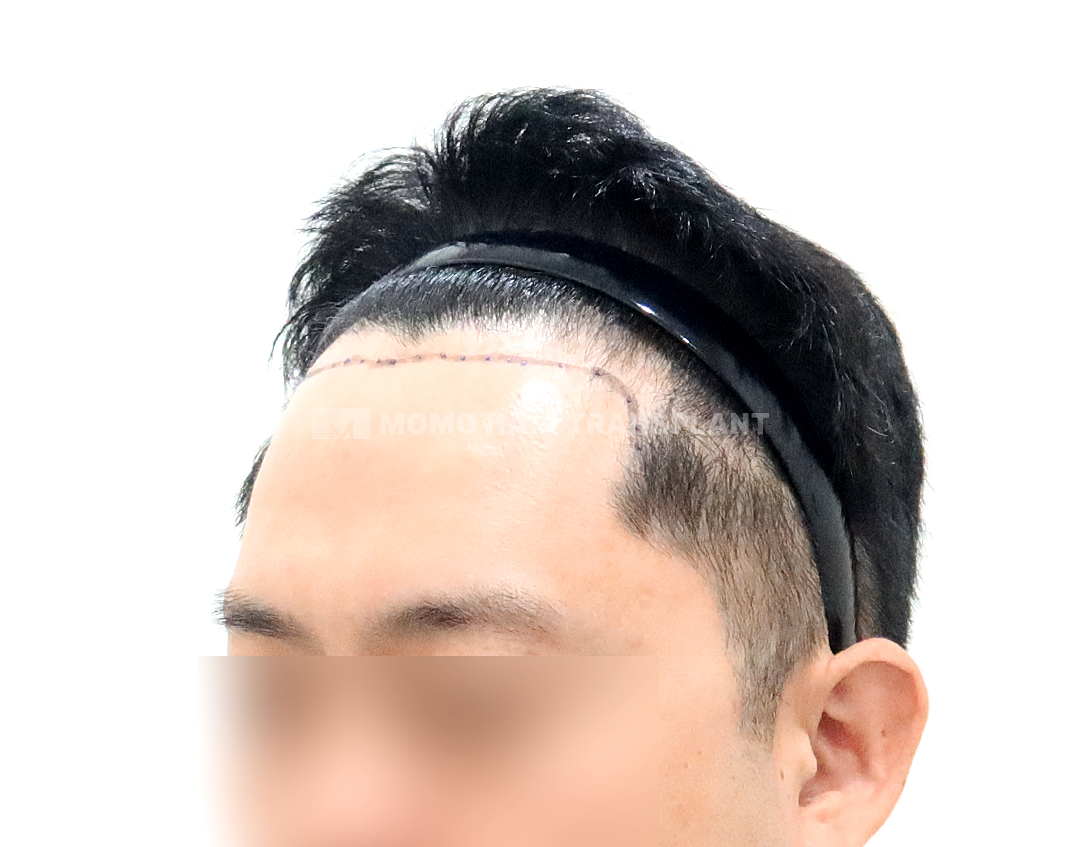 Before