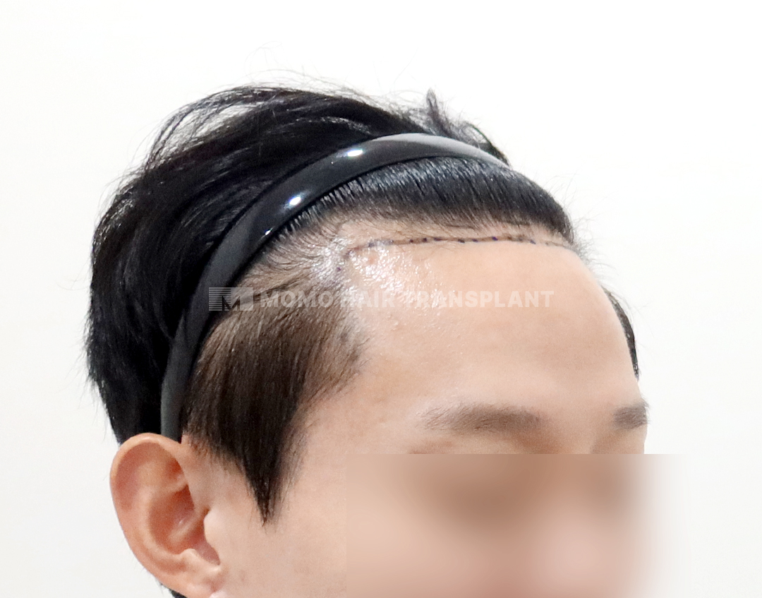 Before