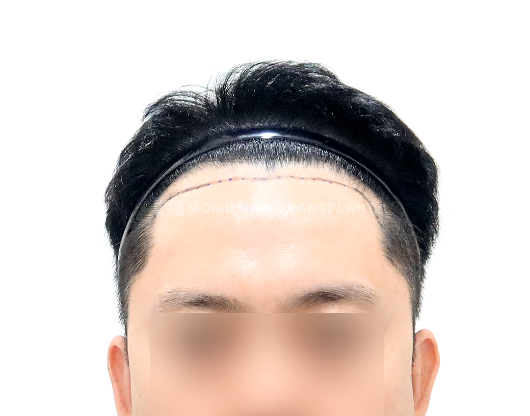 Before