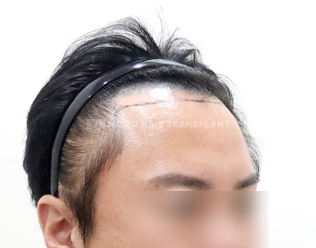 Before