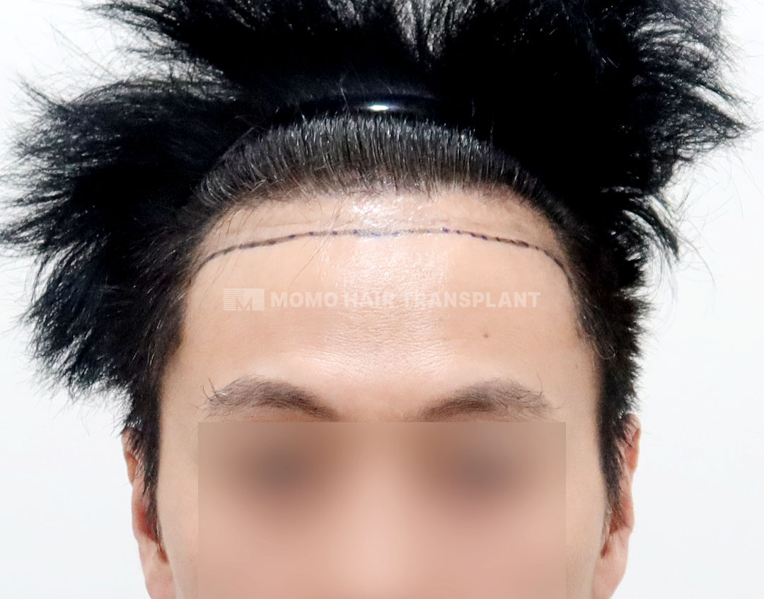 Before