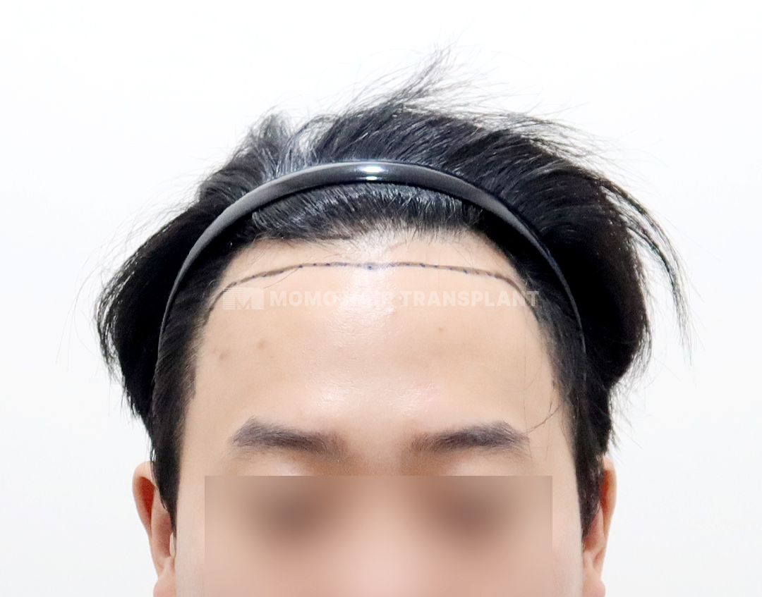 Before