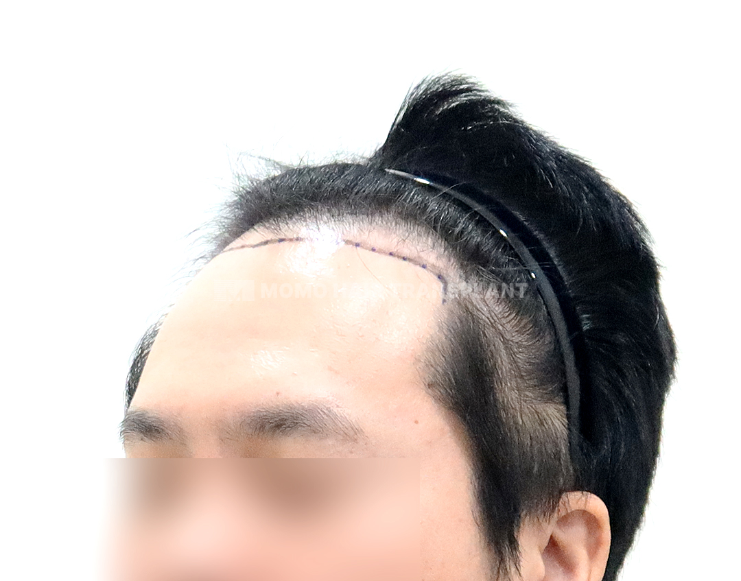 Before
