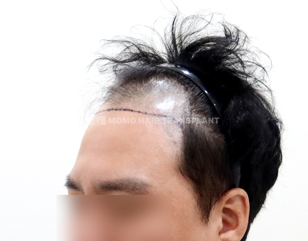 Before