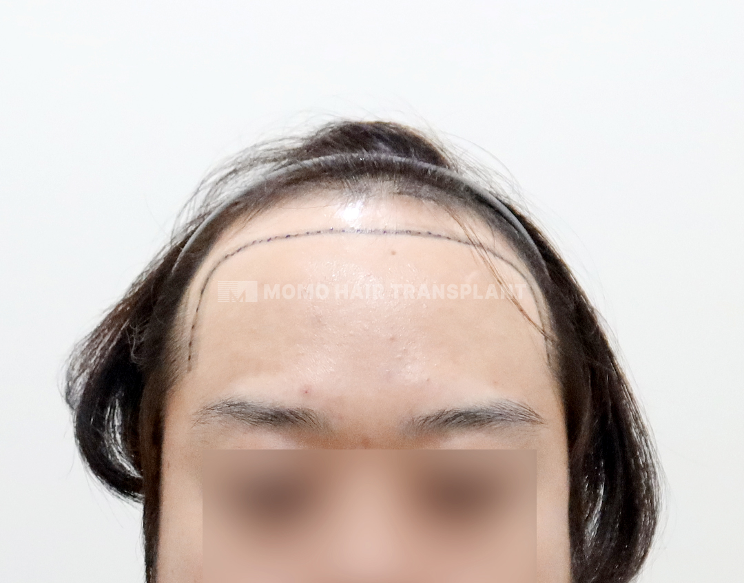 Before