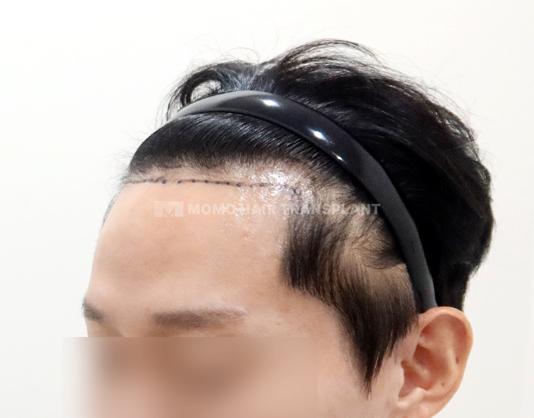 Before