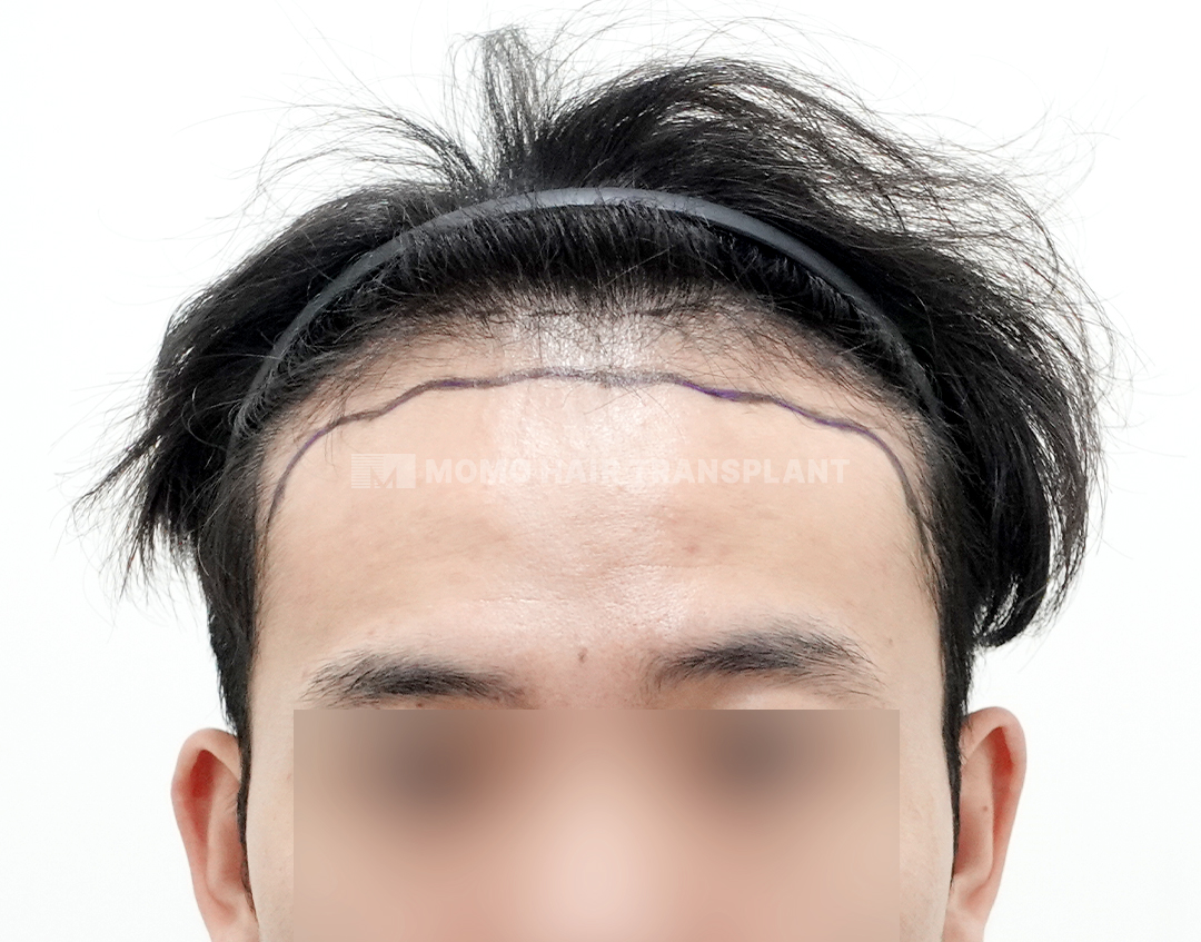 Before