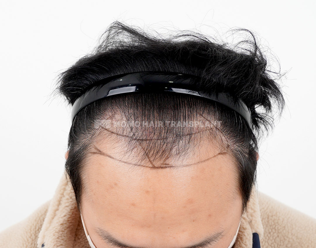Before
