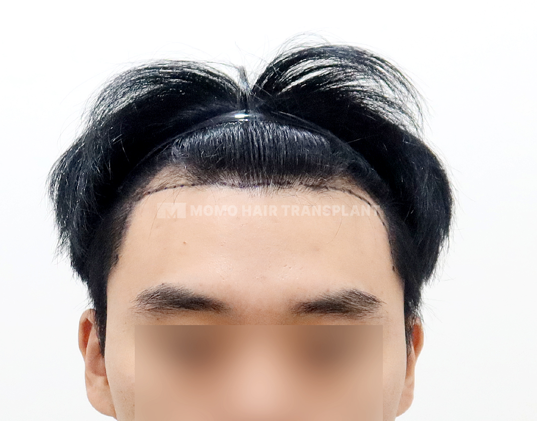 Before