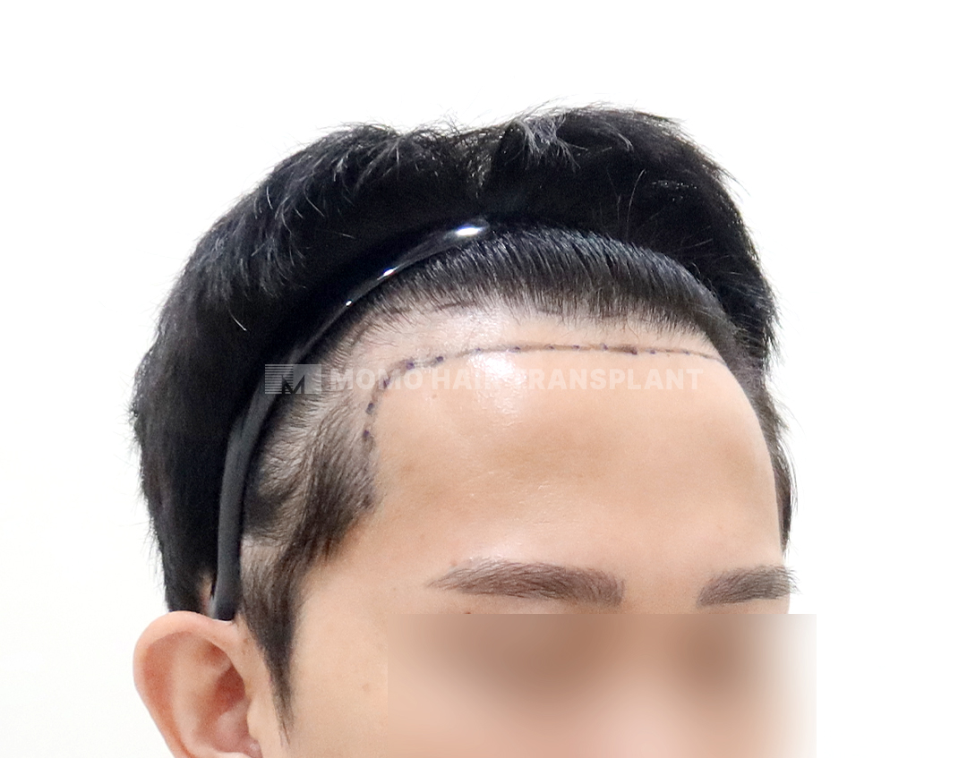 Before