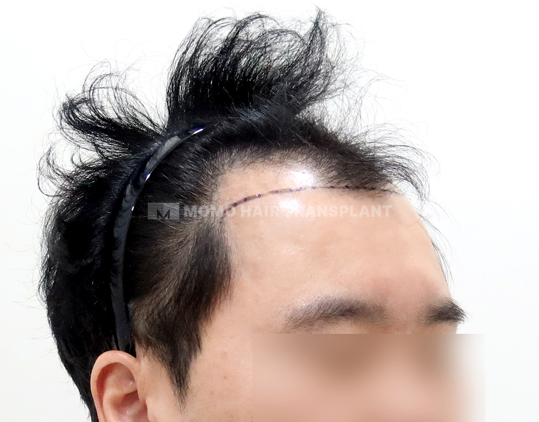Before