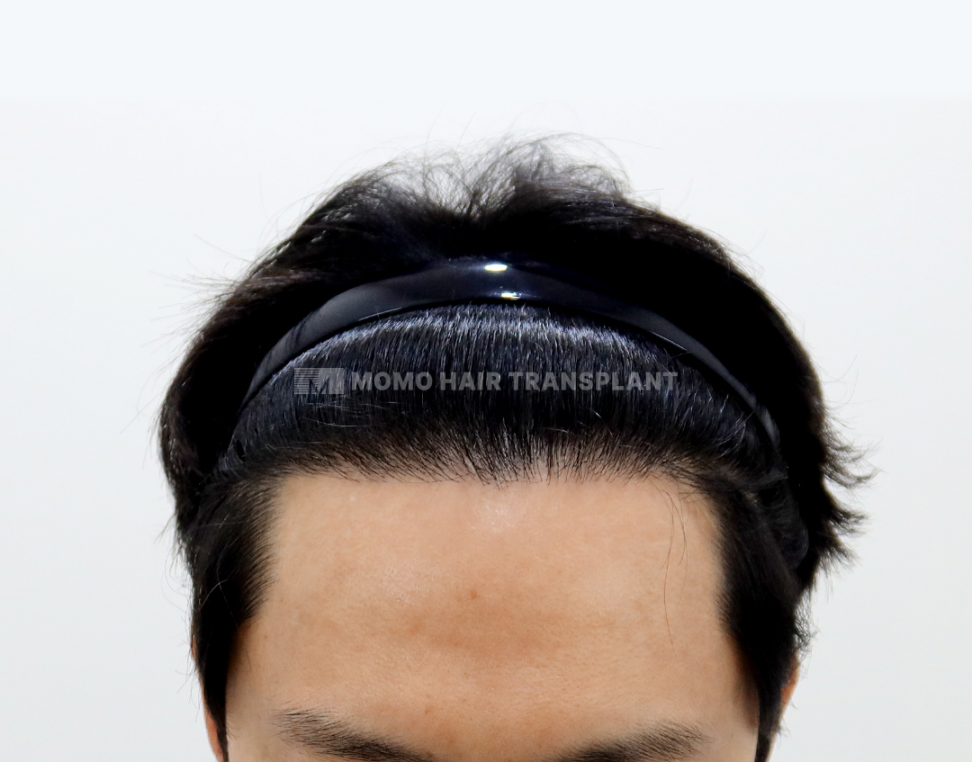 After