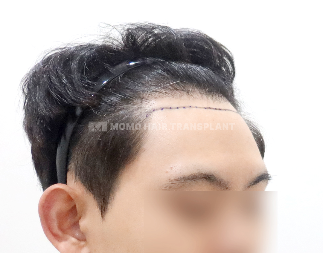 Before