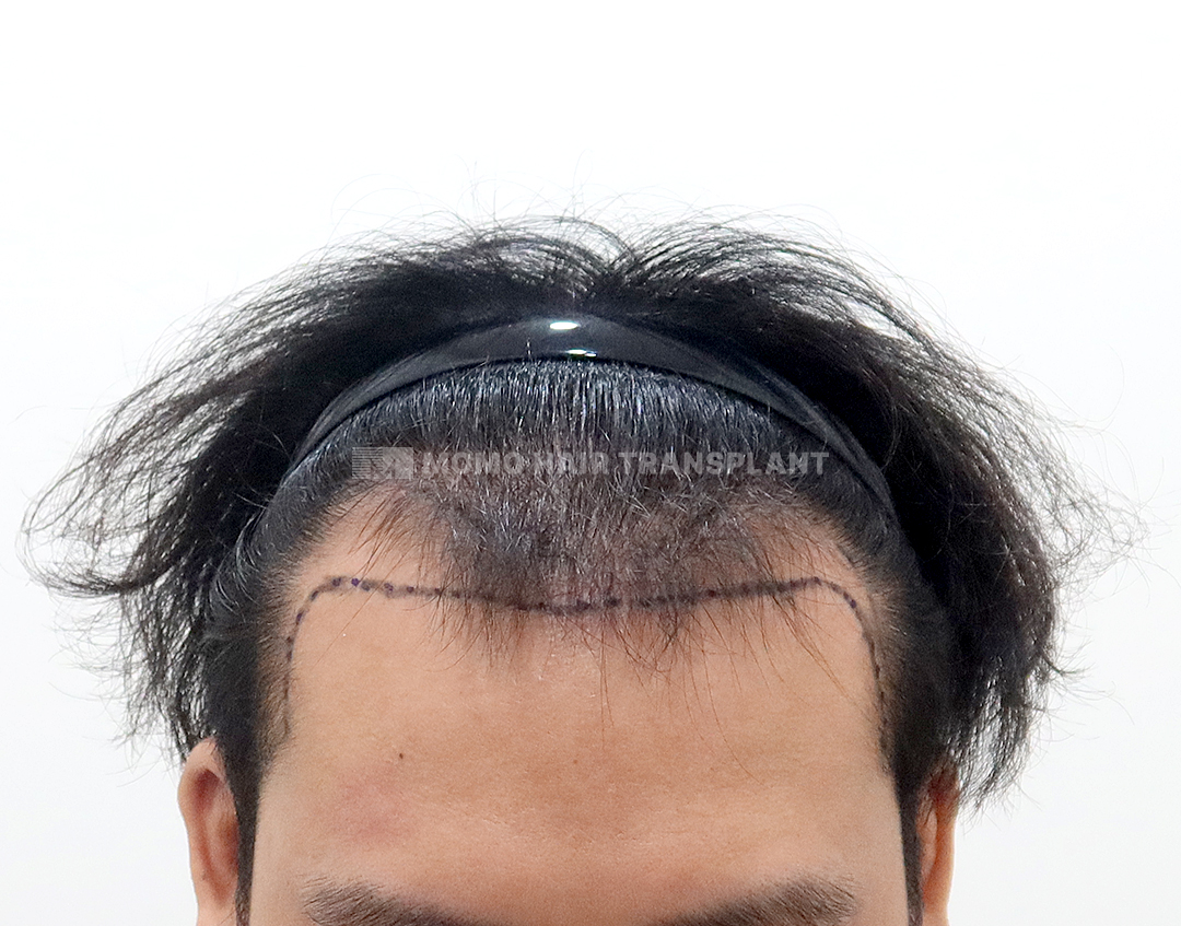 Before