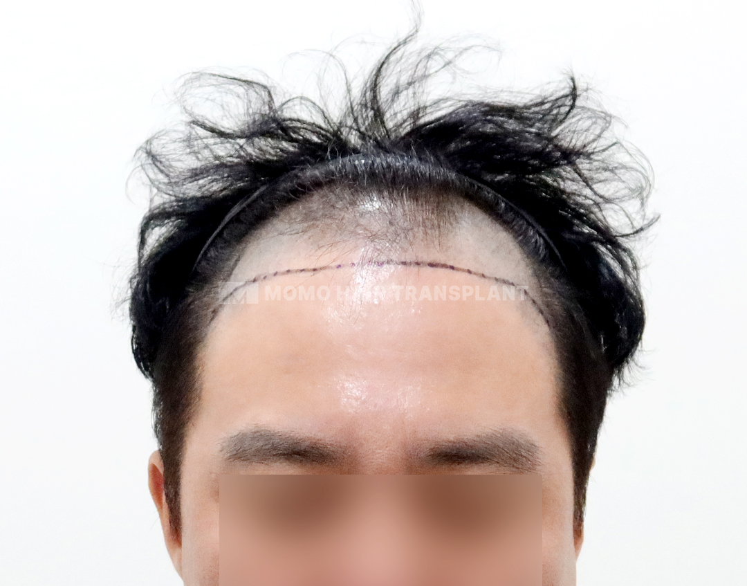 Before