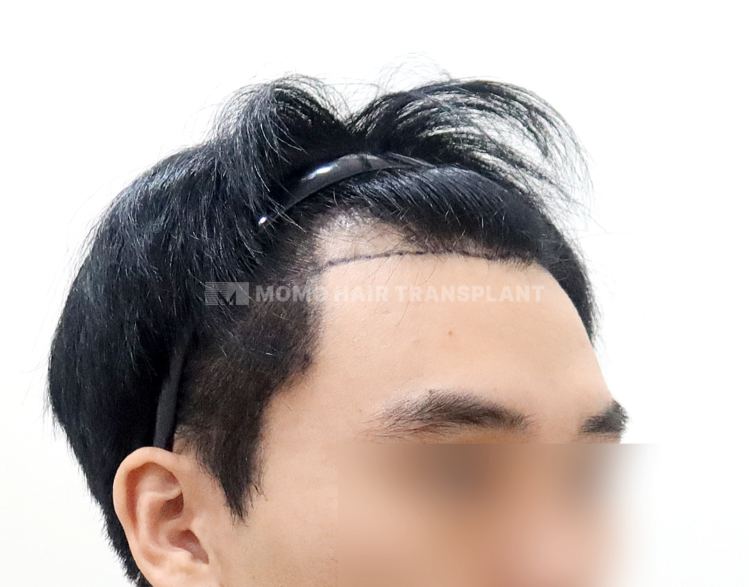 Before