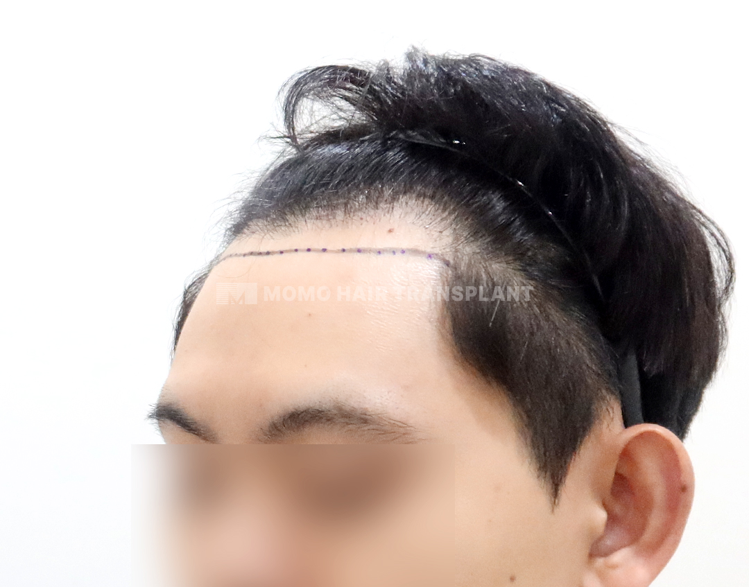 Before