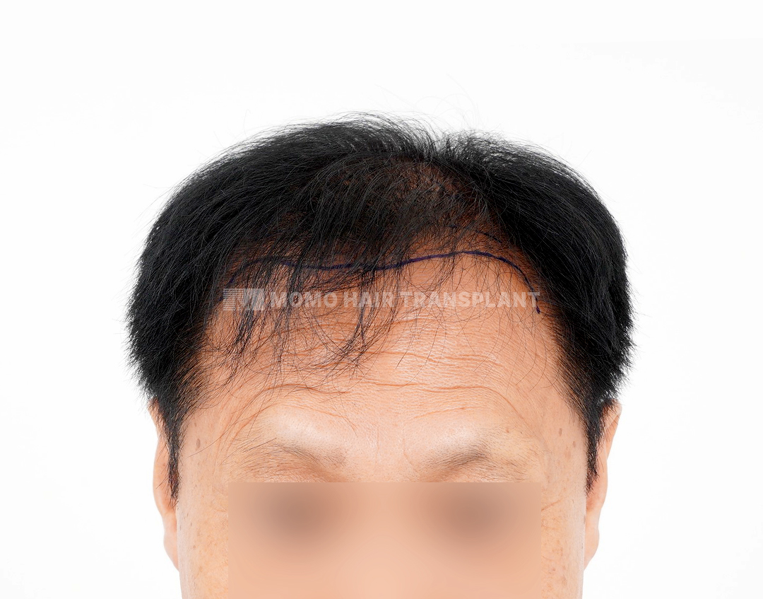 Before