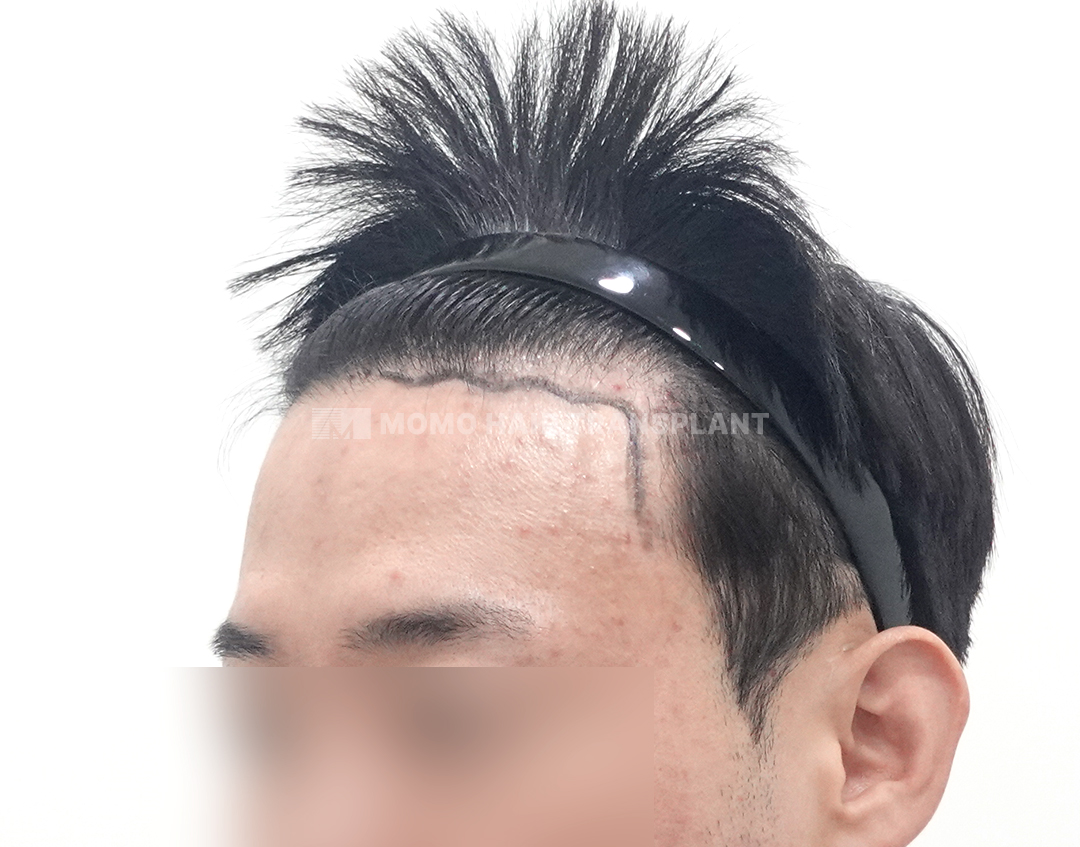 Before