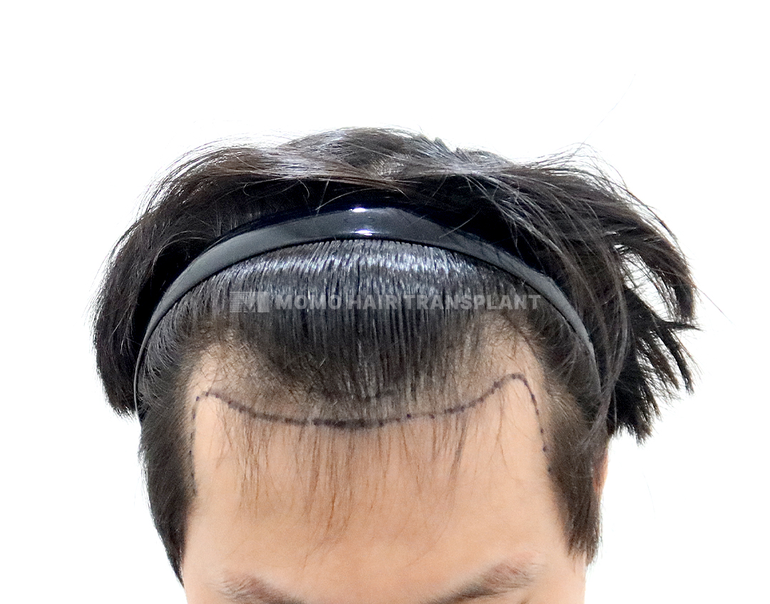 Before